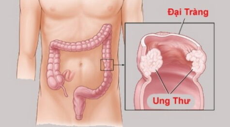 Dấu hiệu sớm cảnh báo ung thư đại tràng