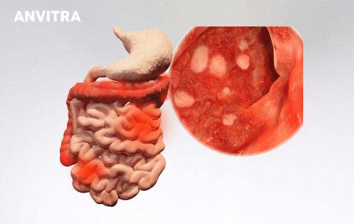 Bệnh Crohn có thể gây viêm nhiễm ở bất kỳ vị trí nào trong đường ruột, trong đó có đại tràng